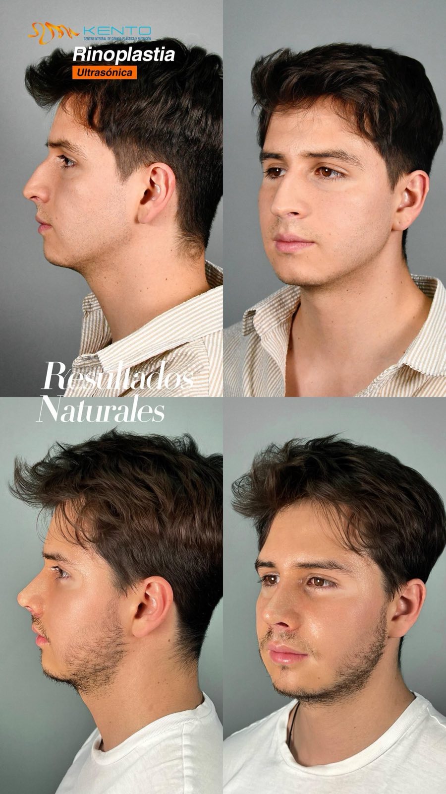 Rinoplastia masculina — collage antes y después caso real